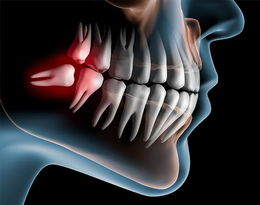 Що робити, коли болить зуб мудрості