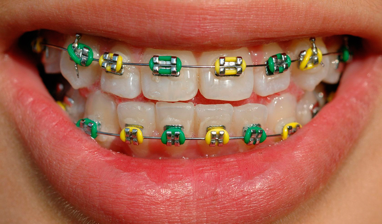 Як доглядати за брекетами