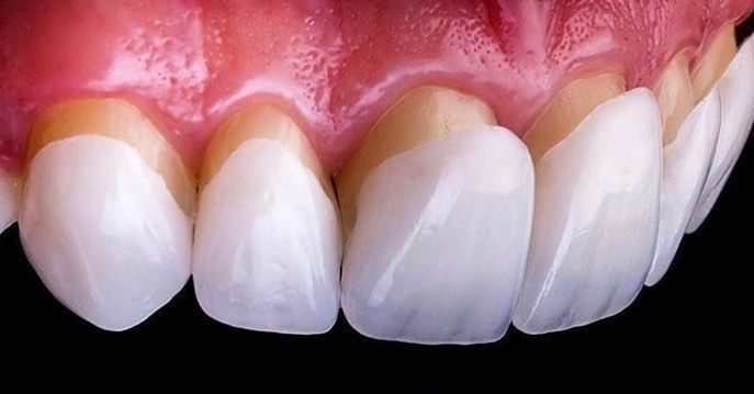 Як відбувається встановлення вінірів?